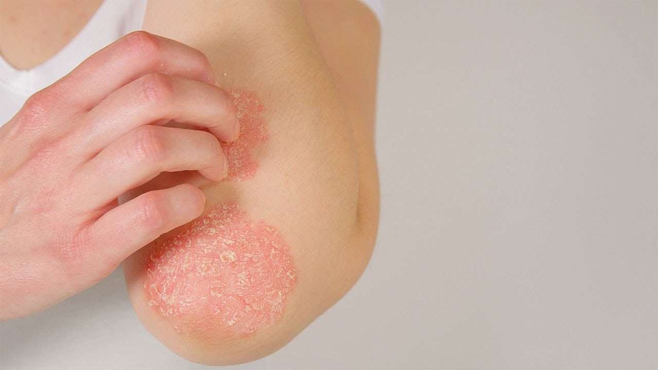 Gestión de la Psoriasis: Aplicaciones Android para el Cuidado de la Piel